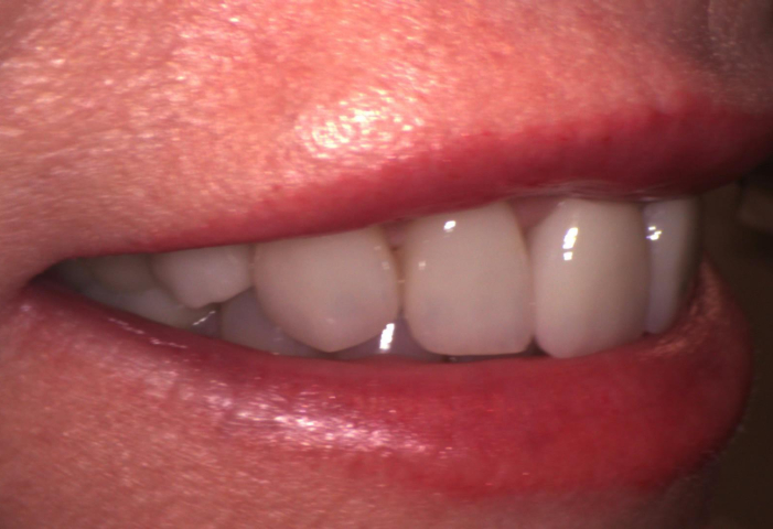 after dental veneers photo