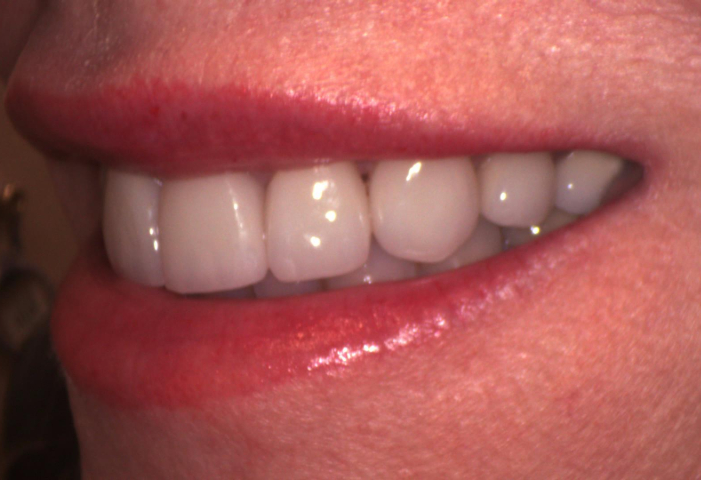 after dental veneers photo